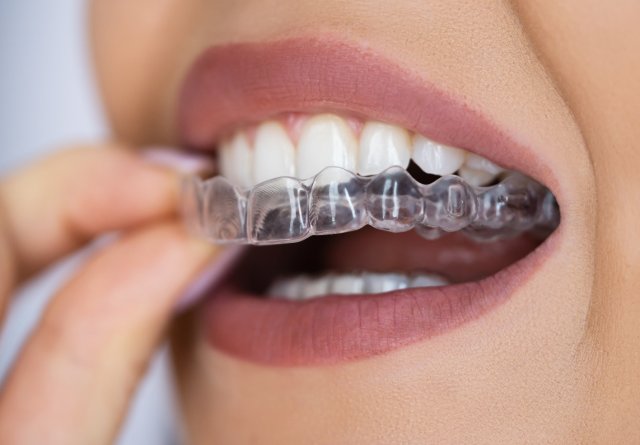 Alignere dentare transparente la Novora