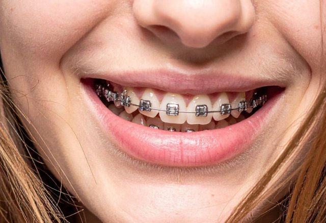 Aparat dentar autoligaturant la Novora