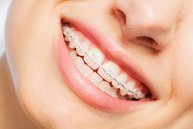 Aparat dentar fix ceramic la clinica Novora