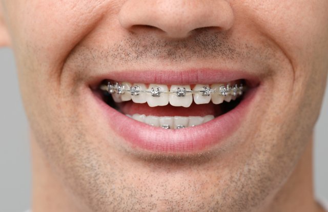 Aparat dentar fix metalic tradițional la Novora