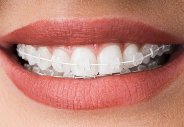 Aparat dentar din safir transparent la Novora