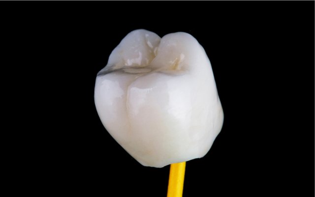 Coroană dentară ceramică stratificată pentru dinții frontali