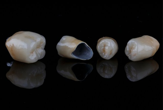 Coroană dentară metalo-ceramică pentru reabilitare orală
