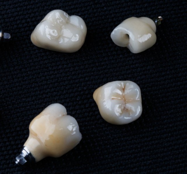 Coroană dentară pe implant la clinica Novora
