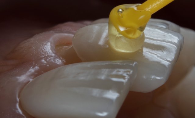Fațete dentare ceramice Emax realizate la Novora