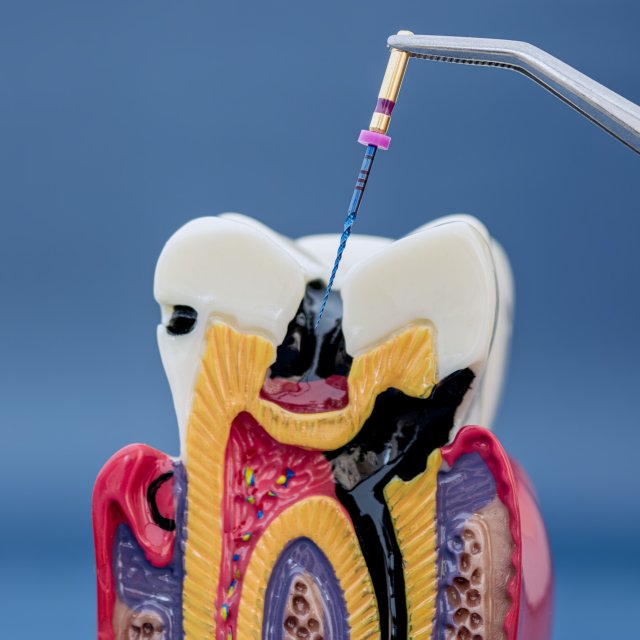 Model anatomic al unui dinte — tratament de canal cu ac endodontic
