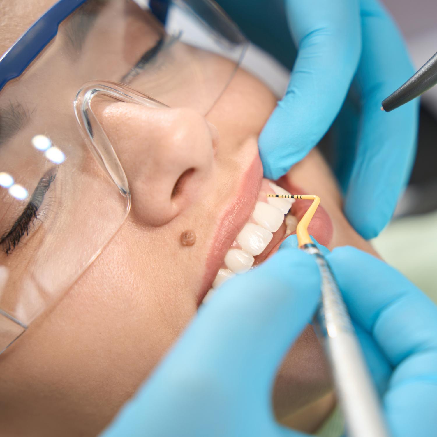 Igienizare orală profesională