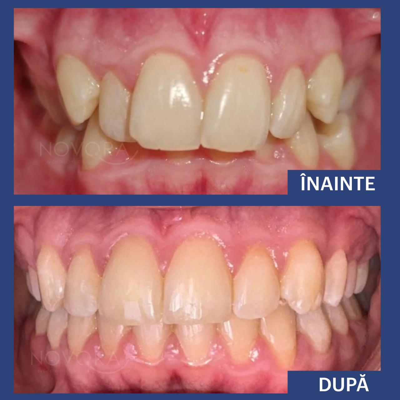 Caz ortodontic: malocluzie Clasa 1 cu înghesuire dentară medie spre severă, inferior și superior