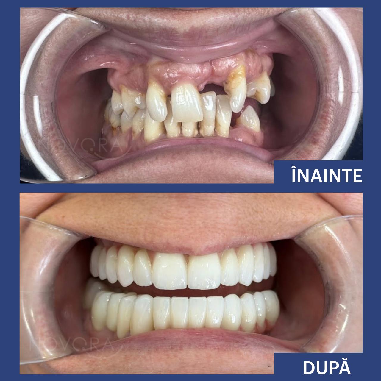 Reabilitare orală funcțională și estetică cu implanturi dentare și Fast & Fixed