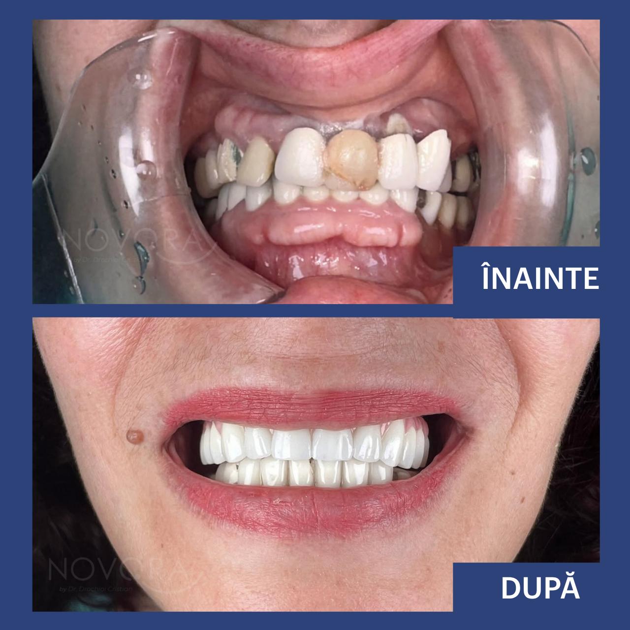 Reabilitare orală completă maxilară cu Fast & Fixed