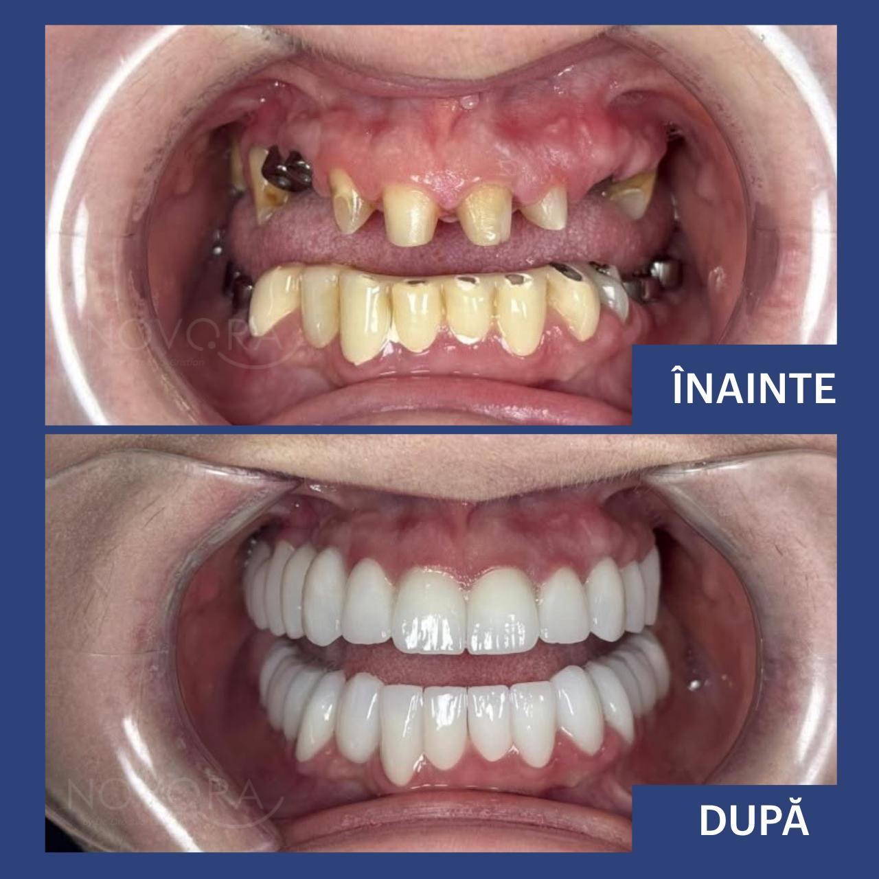 Reabilitare totală a danturii cu lucrări fixe din ceramică pe dinții naturali și pe implanturi dentare