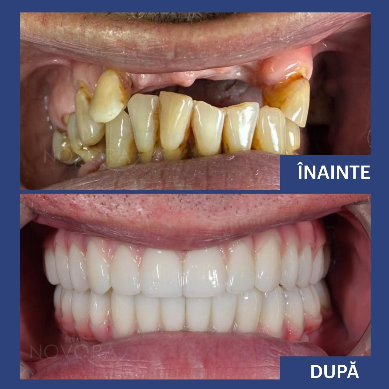 Reabilitare orală completă maxilar și mandibulă cu sistemul de implanturi Fast & Fixed