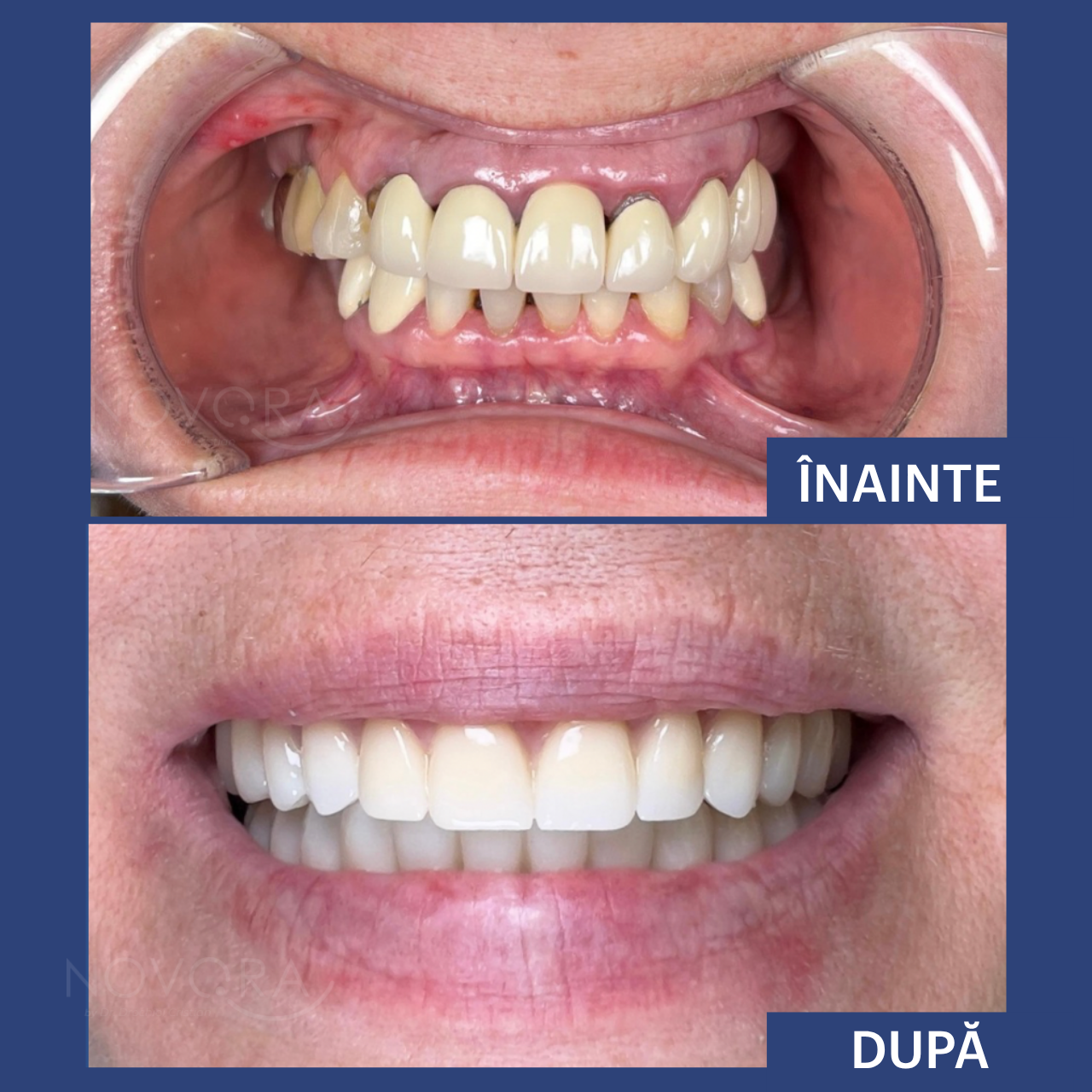 Reabilitare completă dantură cu Fast & Fixed și lucrări protetice din ceramică pe zirconiu