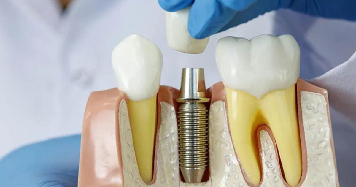 Pot beneficia de implant dentar dacă am osteoporoză?