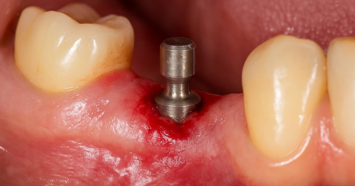 Semnele respingerii unui implant dentar – cum le recunoști