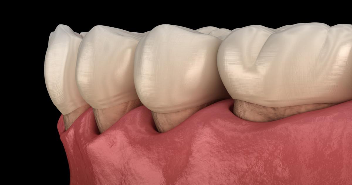 Retragerea gingiilor – cauze, simptome și soluții eficiente