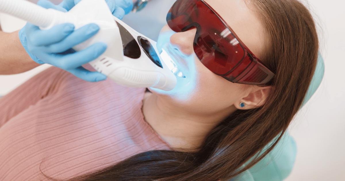 Albirea dentară profesională vs. albirea dentară acasă: tot ce trebuie să știi