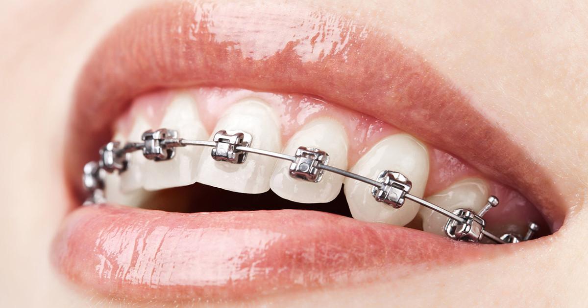 Beneficiile aparatului dentar autoligaturant