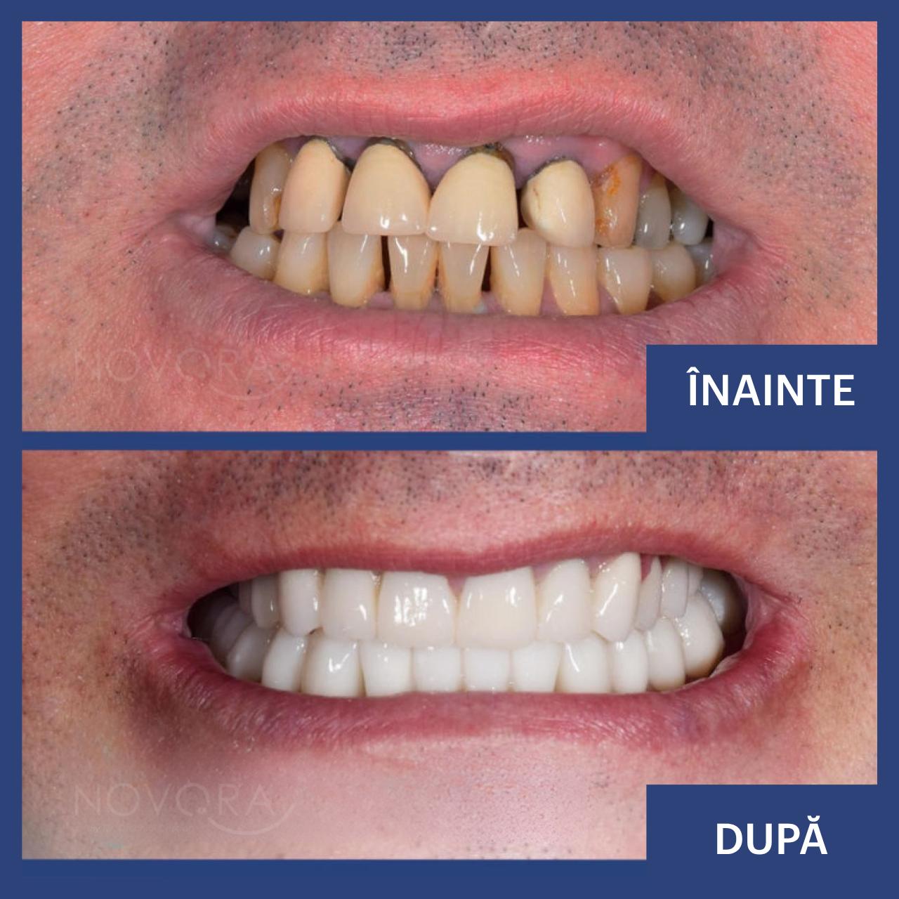 Reconstrucții dentare complete cu implant dentar, coroane din ceramică pe suport de zirconiu (maxilar și mandibulă) și tratamente endodontice