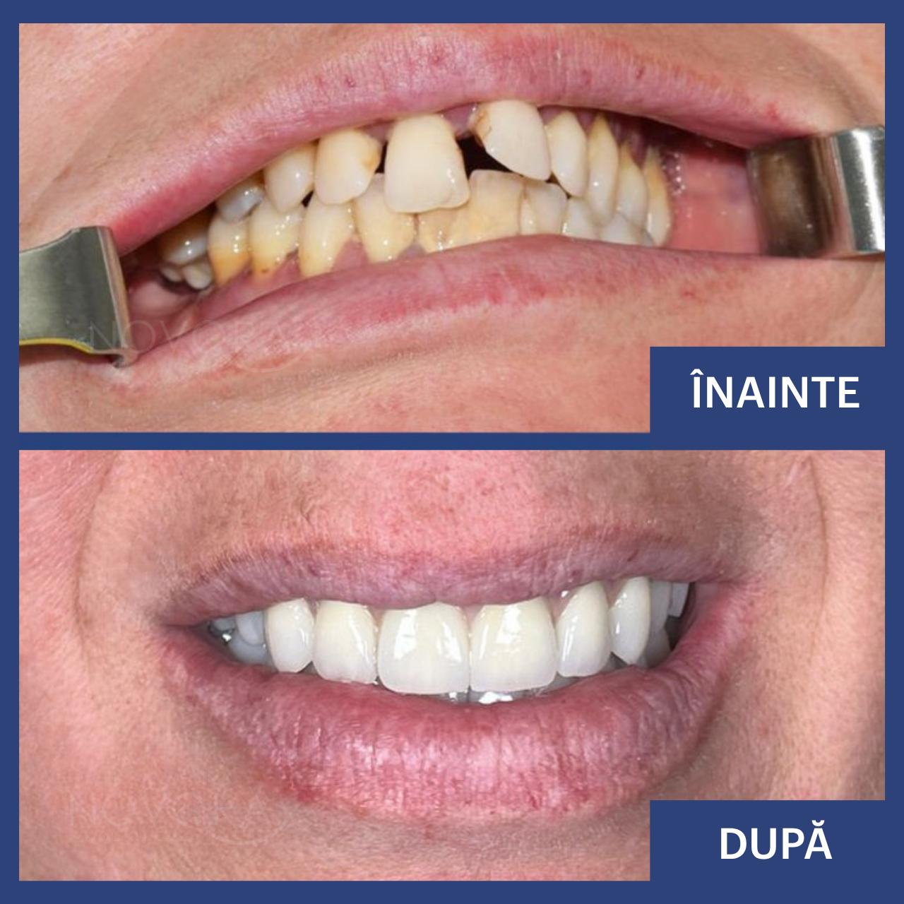 Sistem de implanturi dentare Fast&Fixed și lucrare provizorie în 24h